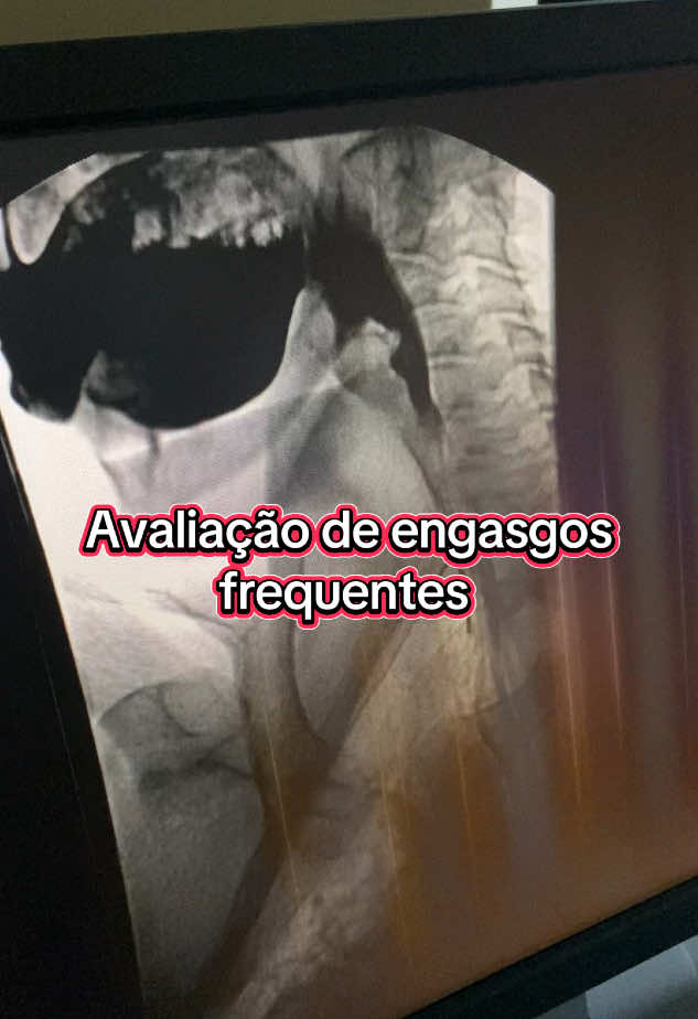“Deglutograma”. #radiology #radiologia #med #fyp 