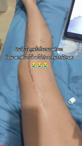 😭😭😭😭 #ขาหักดามเหล็ก #กายภาพบําบัด #อุบัติเหตุชนท้ายกระบะ #สะบ้าแตก #ต้นขาหัก 