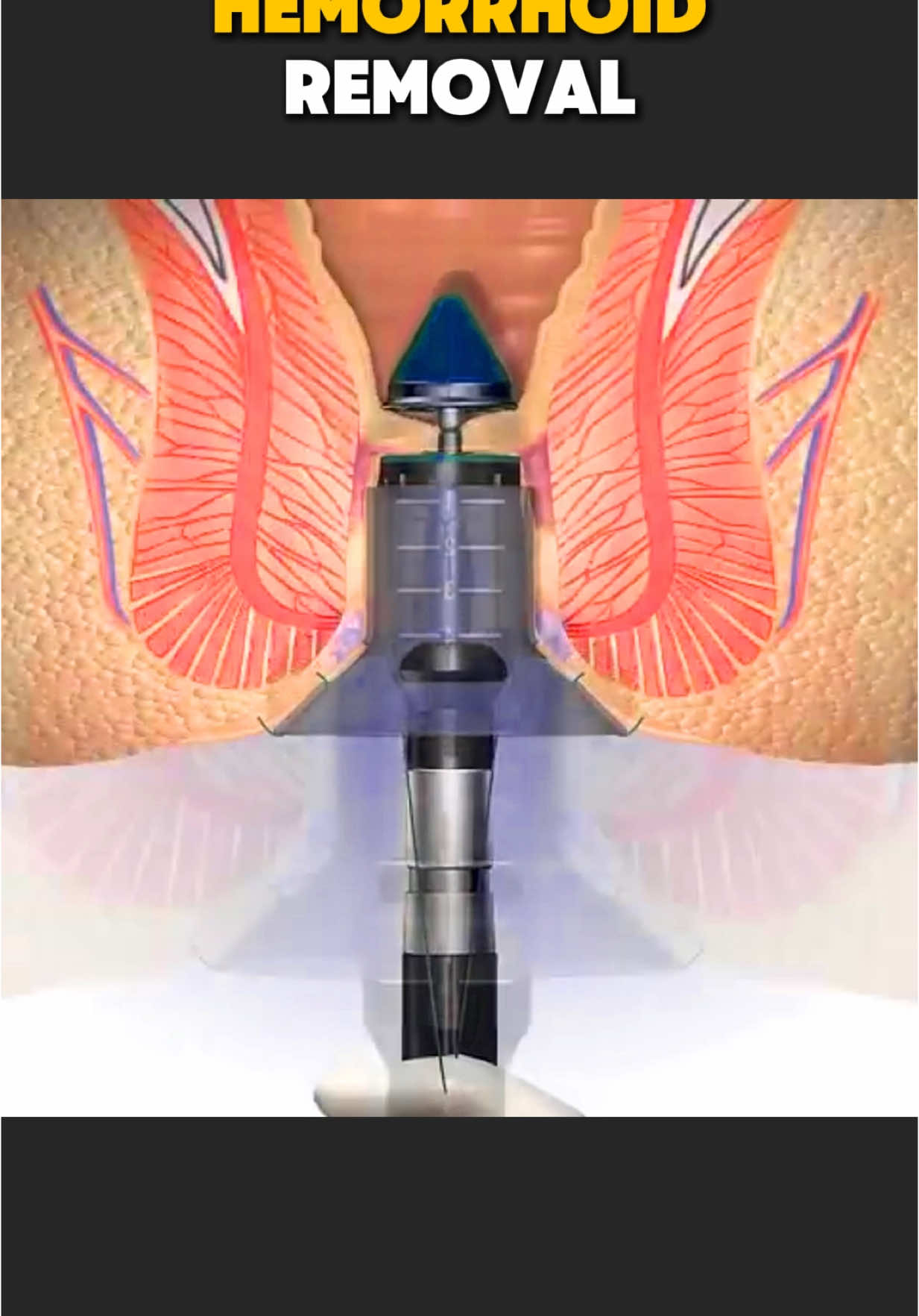 Stapled Haemorrhoidectomy using the PPH System (3D Animation) #stapledhemorrhoidectomy #stapledhemorrhoid #hemorrhoids #hemorrhoidectomy #hemorrhoidsurgery #piles #pilessurgery #medical3danimation #3dmedicalanimation 