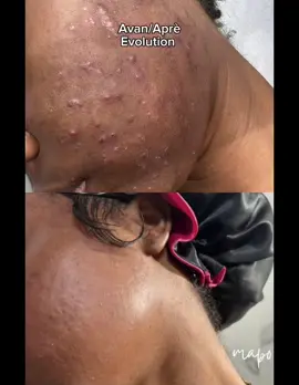 Ou pran ti tan pou  envesti nan po ou deja ? Mwen ka ede ou trete e konprann po w. @Kla | Skin influence 🧚🏾‍♀️   #haitiantiktok🇭🇹 #skincare #acnetreatment #scartreatment #routineskincare #haitianhaiti #🇭🇹 #acneproneskin #haitianusa #acne  @Kla | Skin Influence🧚🏼‍♀️ 