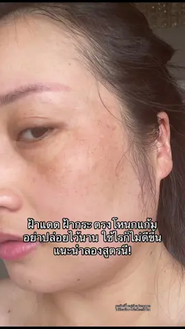 เรื่องฝ้าายกให้gravich ยืน1 ในใจ #แต้มฝ้าgravich #ฝ้ากระ #ฝ้า #gravich #ใช้ดีบอกต่อ @Gravich Official 