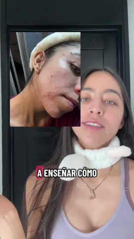 Acompáñame a maquillarme estando en tratamiento de acné #acnetreatment #isotretinoina #skincarecoreano #maquillajetutorial #grwmmakeup 