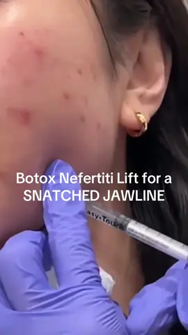 Tips from an Aesthetic Nurse: You need to add a Nefertiti Lift with your Masseter Botox treatments to get the ULTIMATE SNATCHED JAWLINE 😍🔥✨ Treating your Masseters is also incredible for reducing your TMJ jaw pain! Recommended by dentists! Results seen in less than a week (when using Jeuveau NewTox) & can last up to 4 months (Jeuveau)💉