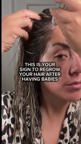 And it’s over 50% off RN RN RN! Ruunnn! Giving updates on this tomorrow!! It’s about time I order my next batch! #vtcosmetics #vtcosmeticshairampoule #postpartumhairloss #howtogrowyourhair #CapCut 