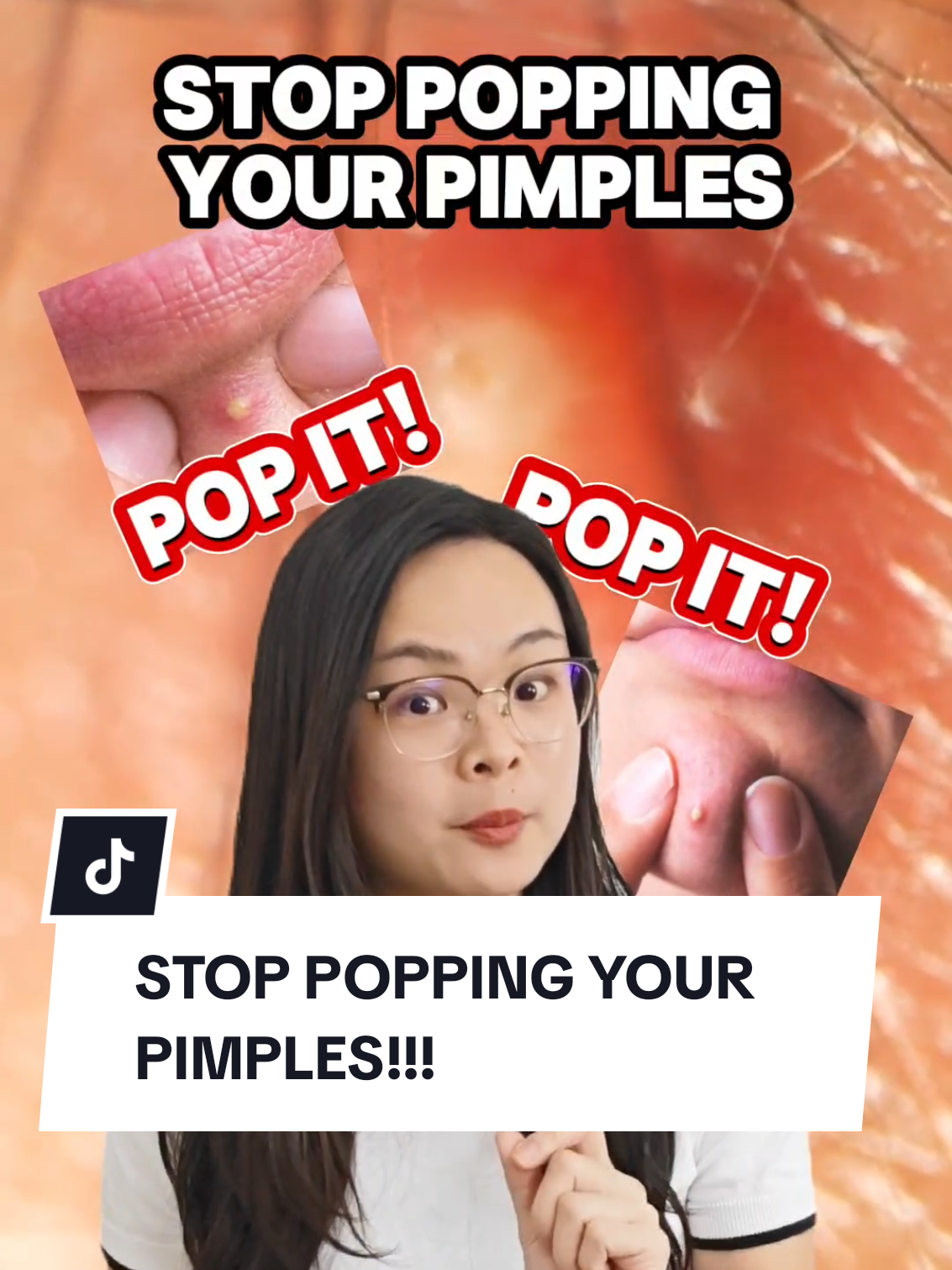 🚫✋ Stop popping your pimples! It can cause scars and more breakouts 😱 Instead, try this 3-step routine: 1. Cleanser 🧼 A foaming gel cleanser with Zinc + Phylobioma Active helps control excess sebum, reduce acne growth, and keep pores clear. 2. Spot Treatment 🎯 Powered by Phylobioma Active (targets acne-causing bacteria & inflammation) and Procerad (helps fade post-acne marks). Treat pimples early before they escalate! 3. Patch 🔖 Use hydrocolloid patches to absorb pus and prevent picking. Remember do not pop your pimples! Prevent pimples from forming instead.  💙 #larocheposayMY #larocheposayskincare #skincareroutine #paidpartnership  #DontPopIt  @larocheposay_my 