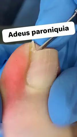Unhas desconfortáveis, andar desconfortável, agora ajudá-lo a resolver#fyp #cortadordeunhas #toenail 