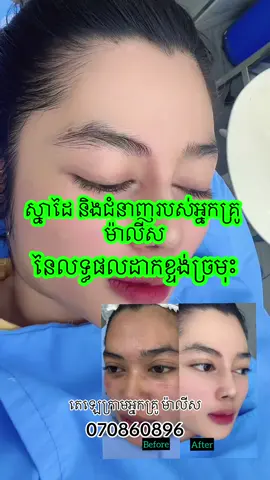 ស្នាដៃអ្នកគ្រូ ម៉ាលីស នៃលទ្ធផលដាក់ខ្ទង់ច្រមុះ  @Malis beauty center  #malisfacialtreatment #សេវាកម្មថែរក្សាសម្ផស្សផ្ទៃមុខ #សេវាកម្មថែរក្សាសម្ផស្សច្រមុះ 
