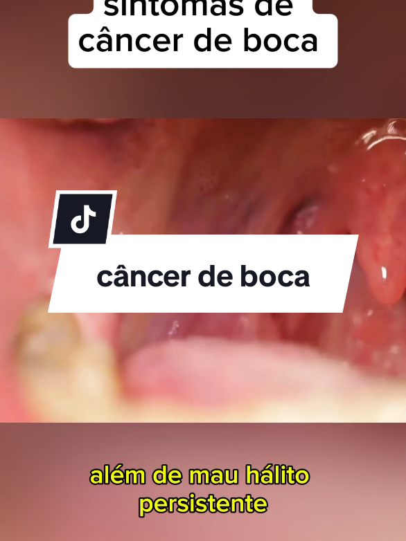 sintomas do câncer de boca #saude #cancerdeboca #cancer 