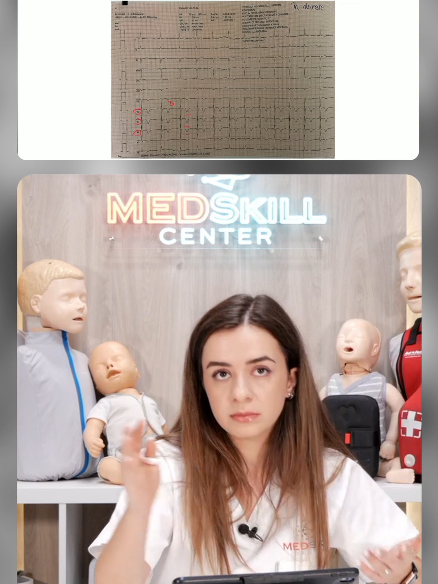 📈 𝐓𝐫𝐨𝐩𝐨𝐧𝐢𝐧𝐚 – 𝐜𝐡𝐞𝐢𝐚 𝐝𝐢𝐚𝐠𝐧𝐨𝐬𝐭𝐢𝐜𝐚𝐫𝐢𝐢 𝐢𝐧𝐟𝐚𝐫𝐜𝐭𝐮𝐥𝐮𝐢 𝐦𝐢𝐨𝐜𝐚𝐫𝐝𝐢𝐜 𝐚𝐜𝐮𝐭! Știai că o valoare a troponinei peste 29 se consideră crescută? 🔍 Totuși, 𝐧𝐮 𝐞 𝐬𝐮𝐟𝐢𝐜𝐢𝐞𝐧𝐭 să te oprești aici. Evaluarea în dinamică 🕒 (la 1–2 ore) este esențială pentru a confirma diagnosticul și a decide pașii următori. 👩‍⚕️ În 𝐰𝐞𝐛𝐢𝐧𝐚𝐫𝐮𝐥 dedicat recunoașterii 𝐢𝐧𝐟𝐚𝐫𝐜𝐭𝐮𝐥𝐮𝐢 𝐦𝐢𝐨𝐜𝐚𝐫𝐝𝐢𝐜 𝐚𝐜𝐮𝐭, 𝒅𝒓. 𝑫𝒊𝒂𝒏𝒂 explică cum corelezi valorile troponinei cu tabloul clinic și cu modificările 𝐄𝐊𝐆. Vei înțelege când un pacient 𝐚𝐫𝐞 𝐧𝐞𝐯𝐨𝐢𝐞 𝐮𝐫𝐠𝐞𝐧𝐭 de 𝐜𝐨𝐫𝐨𝐧𝐚𝐫𝐨𝐠𝐫𝐚𝐟𝐢𝐞 și cum să iei decizia corectă, rapid și cu încredere. 👉 Înscrie-te acum și învață să recunoști semnele subtile care pot face diferența între viață și moarte. 🔗 𝐕𝐞𝐳𝐢 𝐩𝐫𝐢𝐦𝐮𝐥 𝐜𝐨𝐦𝐞𝐧𝐭𝐚𝐫𝐢𝐮 pentru linkul de înscriere. #educatiemedicala #ekg #infarctmiocardic #troponina #diagnosticrapid #studentmedicina #rezidentmedicina #asistentmedical #profesionistimedicali #urgentemedicale #webinarmedicina #formareclinica #healthskills #medskillcenter #medicina2025