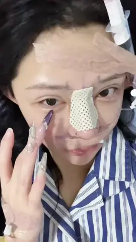 nose job#beautiful #plasticsurgery #rhinoplasty #NoseJob #FacialSurgery 