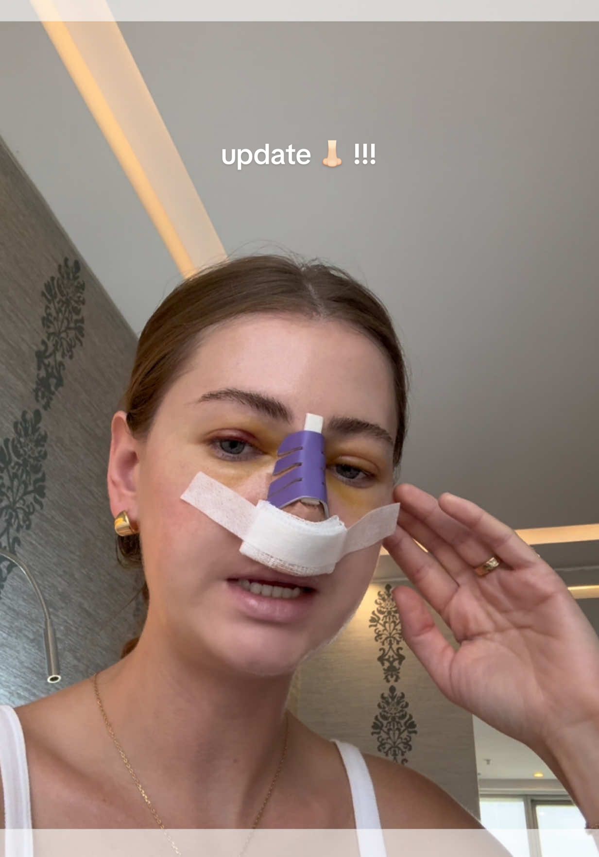 getting there 🙏 it actually kinda looks like eye makeup 😂 #rhinoplasty #nosejob #surgery #postop #turkey 