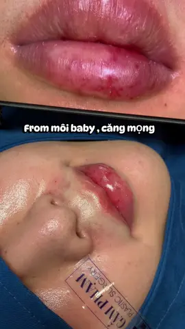 Con trai thì có dc from môi baby?💋#xuhuong #cắt_môi_đẹp #viral #cắt_môi_nam  