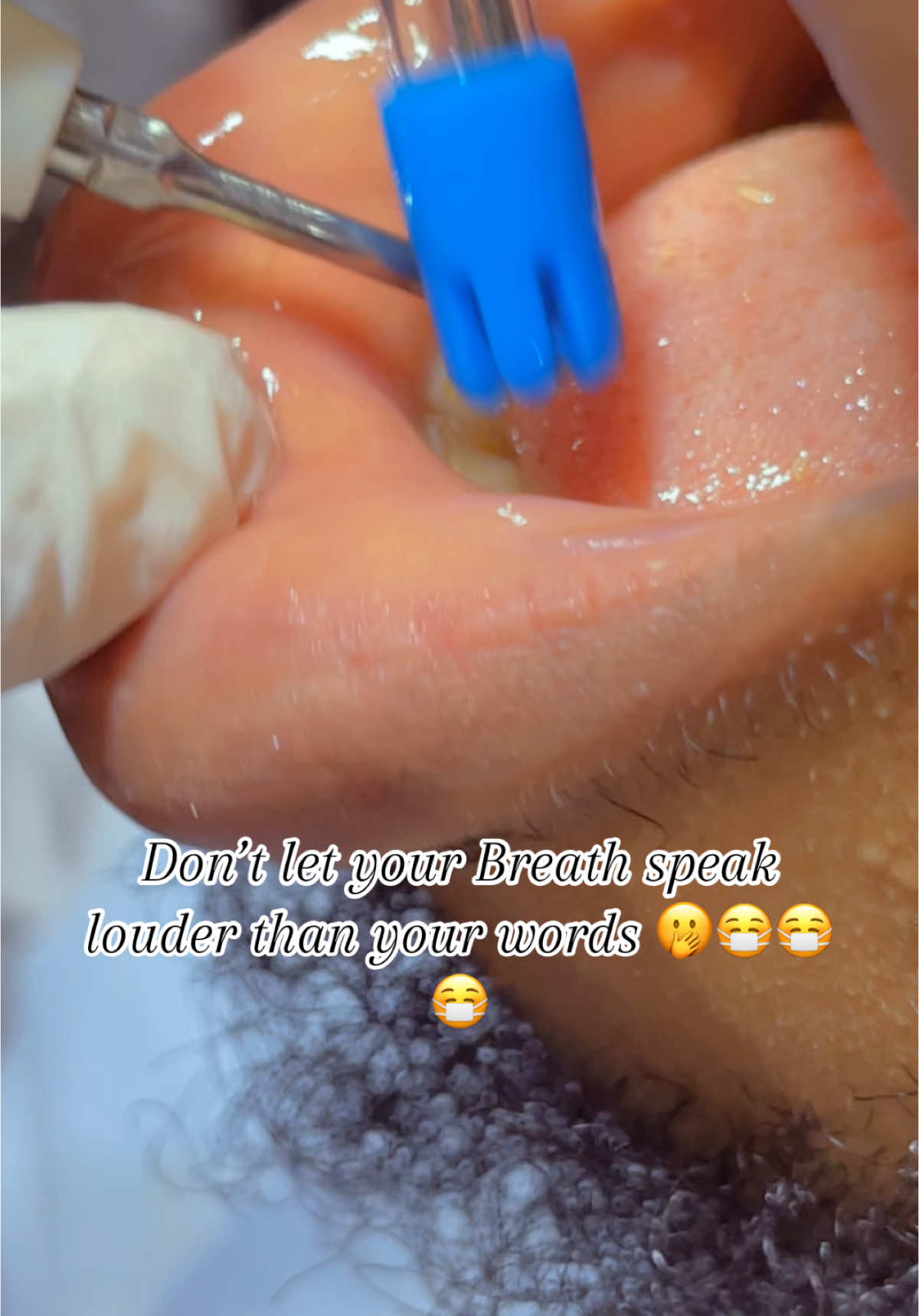 Say No to Bad breath with our Teeth scaling and polishing pro😷😷🦷🦷🫢✅#amokdentals #fyp #makemefamous 