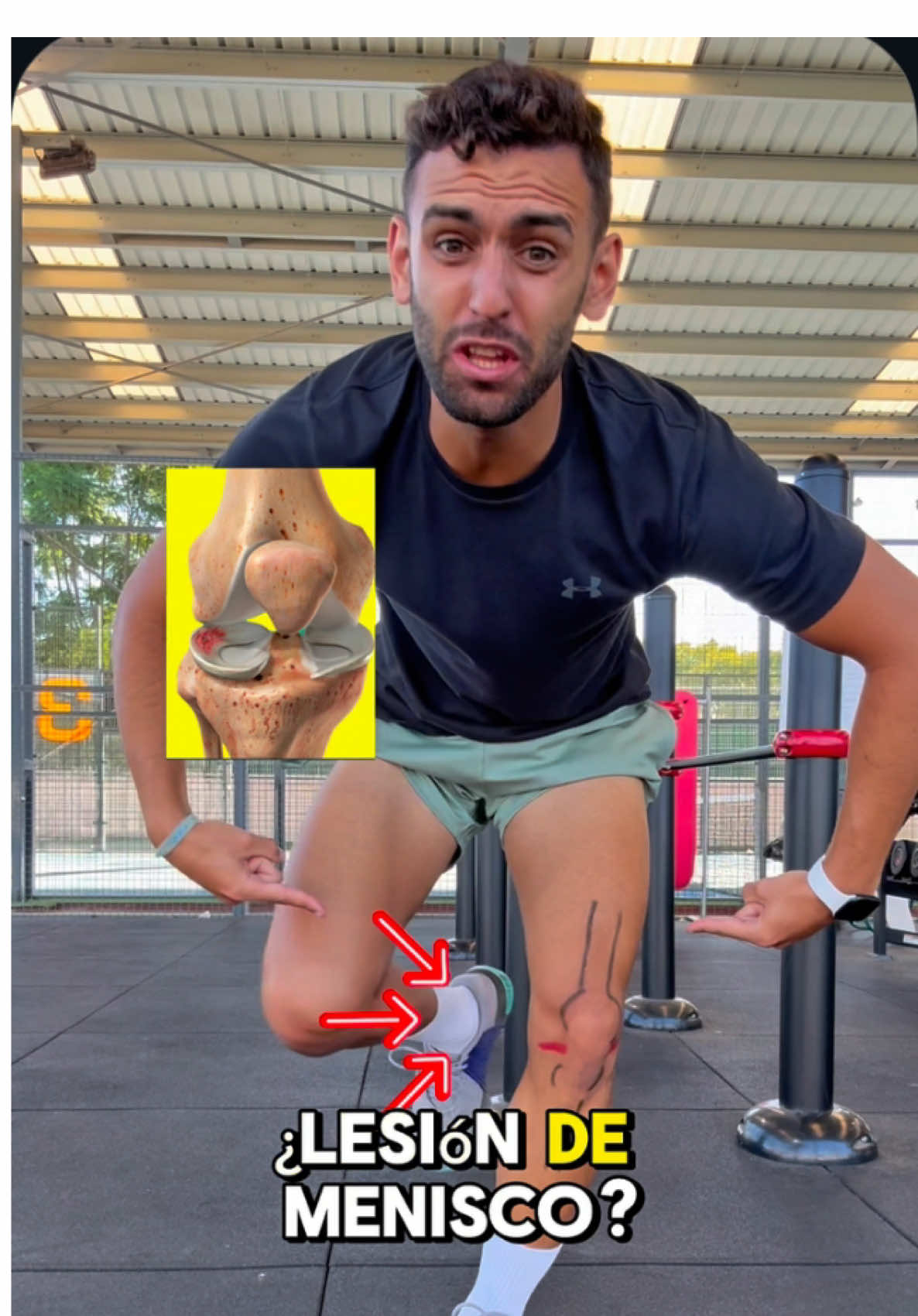Si tu rodilla suena, duele o sientes que “algo no va bien”… cuidado, puede ser el MENISCO. Lo que mucha gente no sabe es que una lesión de menisco no siempre significa “fin del deporte” o “operación obligatoria”.  La mayoría de las veces, con trabajo bien enfocado, puedes recuperar fuerza, movilidad y estabilidad para volver a moverte con seguridad. El problema es que muchos paran por miedo, se quedan sin entrenar y la rodilla cada vez se vuelve más débil. Error. La clave está en hacer los ejercicios correctos, progresivos y específicos para que tu menisco esté protegido y tu rodilla funcione como debe. En este vídeo te enseño movimientos rápidos que: ✅ Activan tu cuádriceps, el guardián de la rodilla ✅ Refuerzan el control y la estabilidad ✅ Te ayudan a recuperar confianza en cada paso y en cada sentadilla Un menisco fuerte significa una rodilla segura, sin miedo y lista para el deporte. 👉 Y ahora dime en comentarios: ¿qué otra lesión te gustaría que explique y que te dé ejercicios para aliviarla? TE LEO 👀 #menisco #adrifisiofitness #dolorrodilla #ejerciciosrodilla #ejerciciosmenisco  