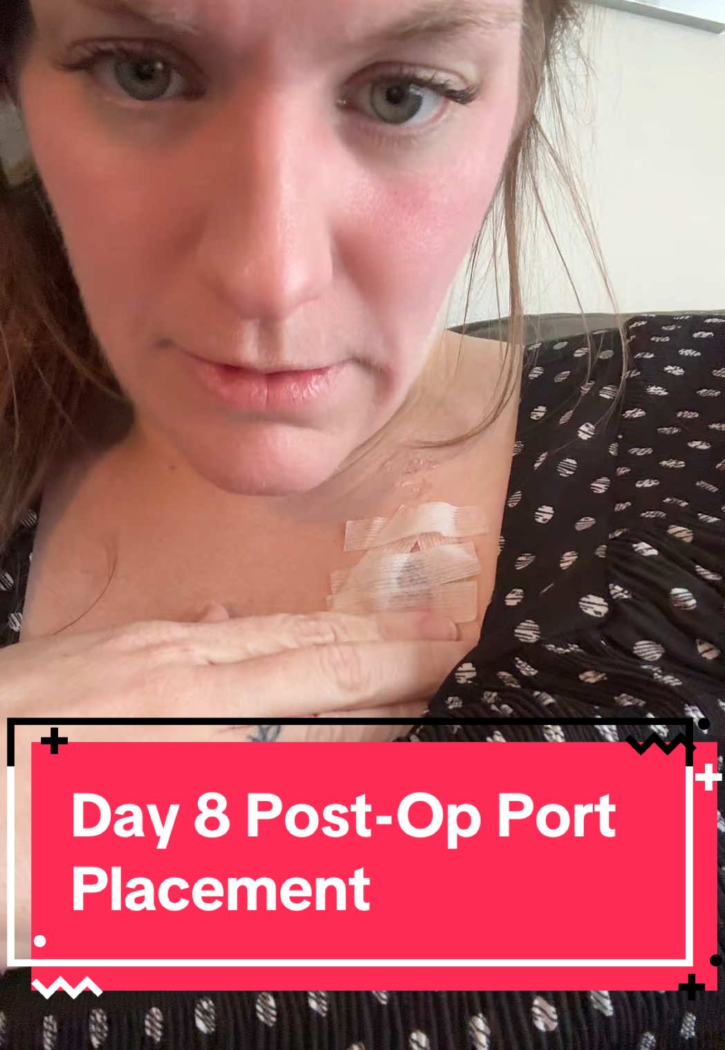 Day 8 Post-Op Port Placement #lupus #powerport #sle #autoimmunedisease #butterflyrash 