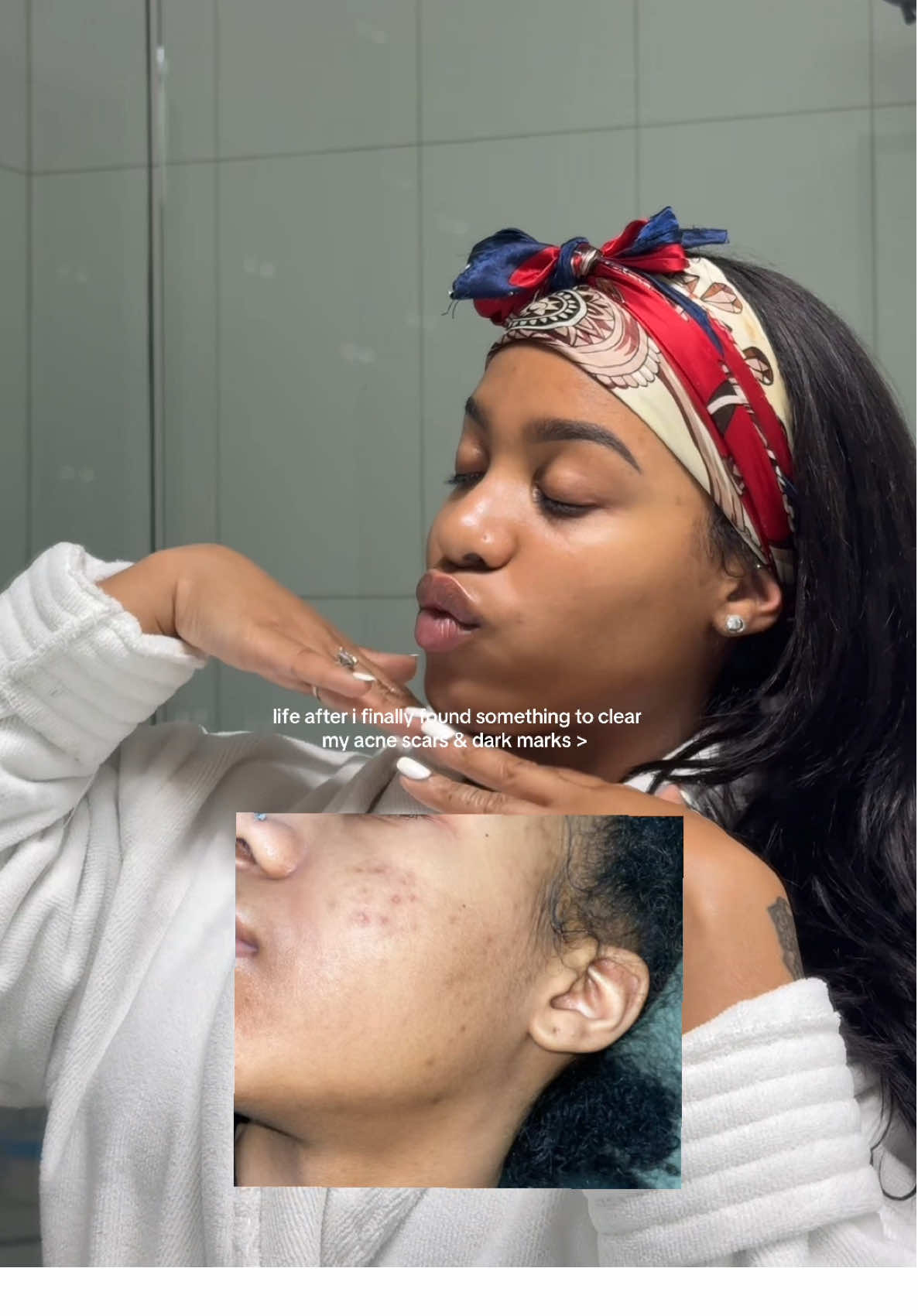Not only has it cleared my acne, but baby.. them dark marks have alllllll faded 😭🥹 thank me later! #viral #skincare #darkmarks #acne #blackgirl 