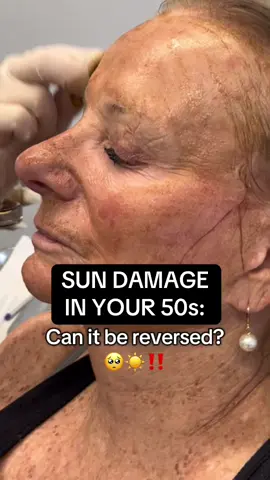 ☀️Years of sun… finally showing up on her skin. Neck, chest, arms — these are the spots most of us forget to protect… until the damage appears. In her 50s, this patient came to us ready for change — not just to treat the sun damage, but to heal her skin. LIMITED SPOTS AVAILABLE at Derm & Rejuvenation in Santa Monica, CA💟 310-526-8301 ✨ info@drkormeili.com 💉 www.DrKormeiliDermatology.com #Skincancer #sundamage #sunspots #antiaging #over50  