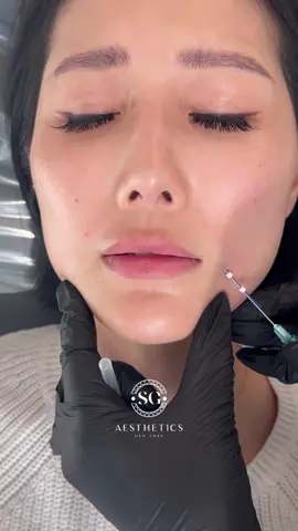PDO threads for nasolabial folds #nasolabialfolds #smilelines #fillers #botox 