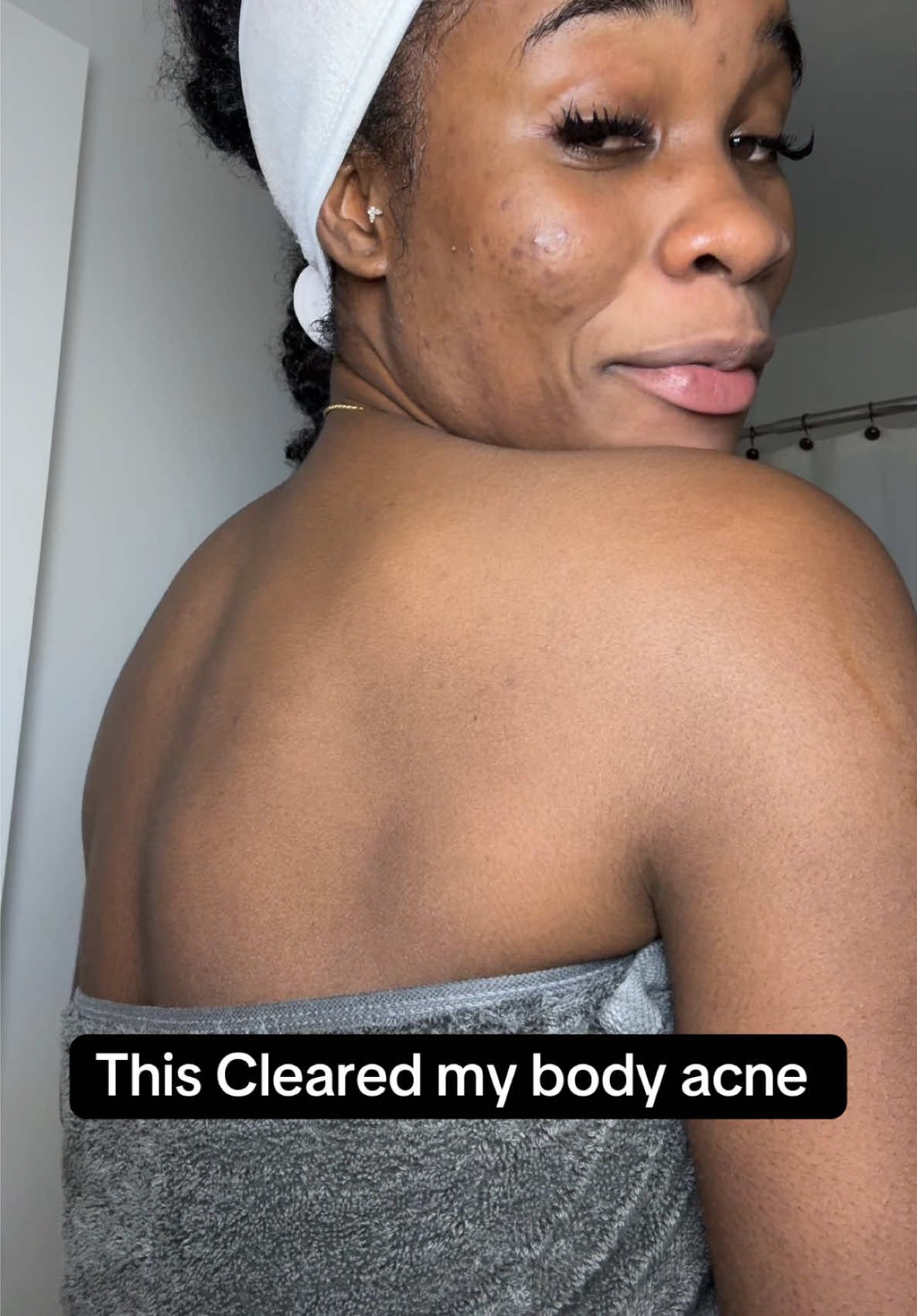 #koreanskincare #acnetreatment #bacne #chestacne #somebymi 