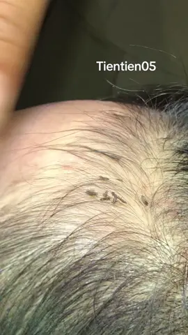 Remove lice #removal #omg ❤️❤️❤️#lice 🥰🥰🥰