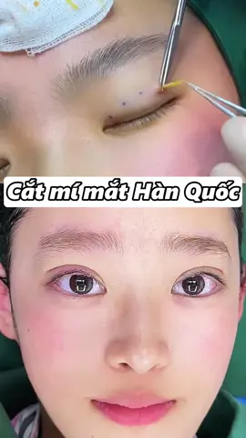 #catmihanni #mimatunhien #thammyvien #mắt_2_mí #mímắtdưới #mắt #PTTM #Phẫuthuậtmắthaimí 