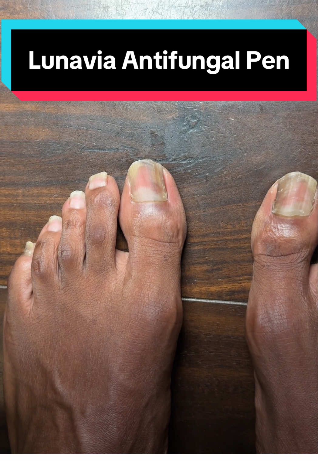 Replying to @Medusa 🦉🪷🌸💐 Day 20 of my feet journey... #TikTokShopCreatorPicks #toefungus #HealthMustHaves #Pedicure #tiktokshoplaborday 