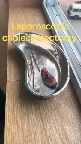 Laparoscopic cholecystectomy 