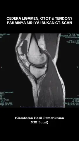 MRI lutut adalah pemeriksaan pencitraan diagnostik yang menilai struktur internal lutut secara rinci, termasuk tulang, tulang rawan, ligamen, tendon, otot, meniskus, dan pembuluh darah, untuk mendiagnosis cedera, peradangan, tumor, infeksi, dan kondisi lain yang menyebabkan nyeri, bengkak, atau ketidakstabilan.  #mri #lutut #Radiografer #radiology 