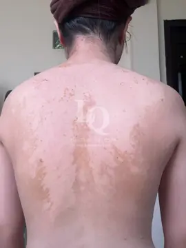 Cập nhật da mụn lưng #chamsocdamun#chamsocdanam#chamsocdaseo#lequynhspa#hocnghespa 