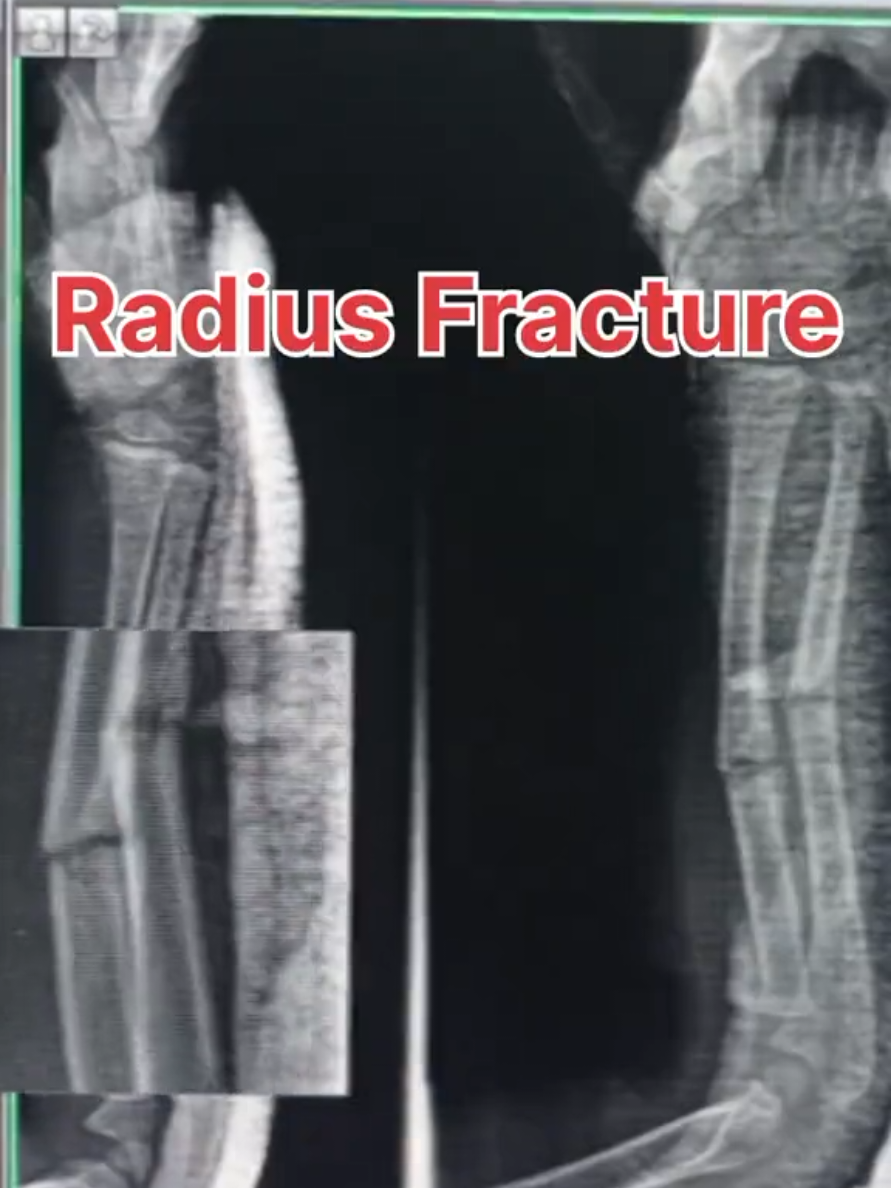 #onthisday #radiologytechnologist #specialcase #radiologist #radiologytiktok 