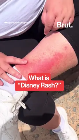 Disney rash, also known as exercise-induced vasculitis, is a temporary skin condition that can occur after prolonged physical activity, especially in hot and humid conditions. #disneyrash #disney #disneyland #rash #skincare