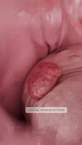 Could a lump at the back of your tongue be thyroid tissue? Ectopic thyroid in 3D Ectopic lingual thyroid is a congenital anomaly where functional thyroid tissue forms at the base of the tongue. This rare condition occurs due to a defect in the embryonic migration of the thyroid gland from the tongue to its normal neck position. Here’s what you need to know: ➡️ It is often associated with an underdeveloped or absent normal thyroid gland (hypothyroidism). ➡️ While it can be asymptomatic, it may also present with symptoms like a sense of a throat mass, difficulty swallowing (dysphagia), or hypothyroidism. ➡️ Diagnosis is confirmed through imaging like thyroid scintigraphy (a nuclear medicine scan) and blood tests to check thyroid function. 📌 Explore this fascinating embryological anomaly in stunning detail with VOKA 3D Anatomy & Pathology! #Endocrinology #Thyroid #3danimation #humanbody #3Danatomy            