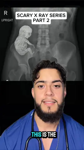 Scary x-ray part 2 #doctor #xray #explore #reels ##medicine 