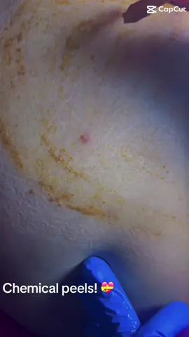 #chemicalpeel 
