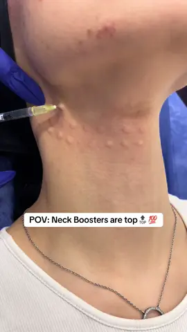 حقن النضارة للرقبة لا تقل اهمية تماما و مثلها و مثل الوجهة  #booster #skinbooster 