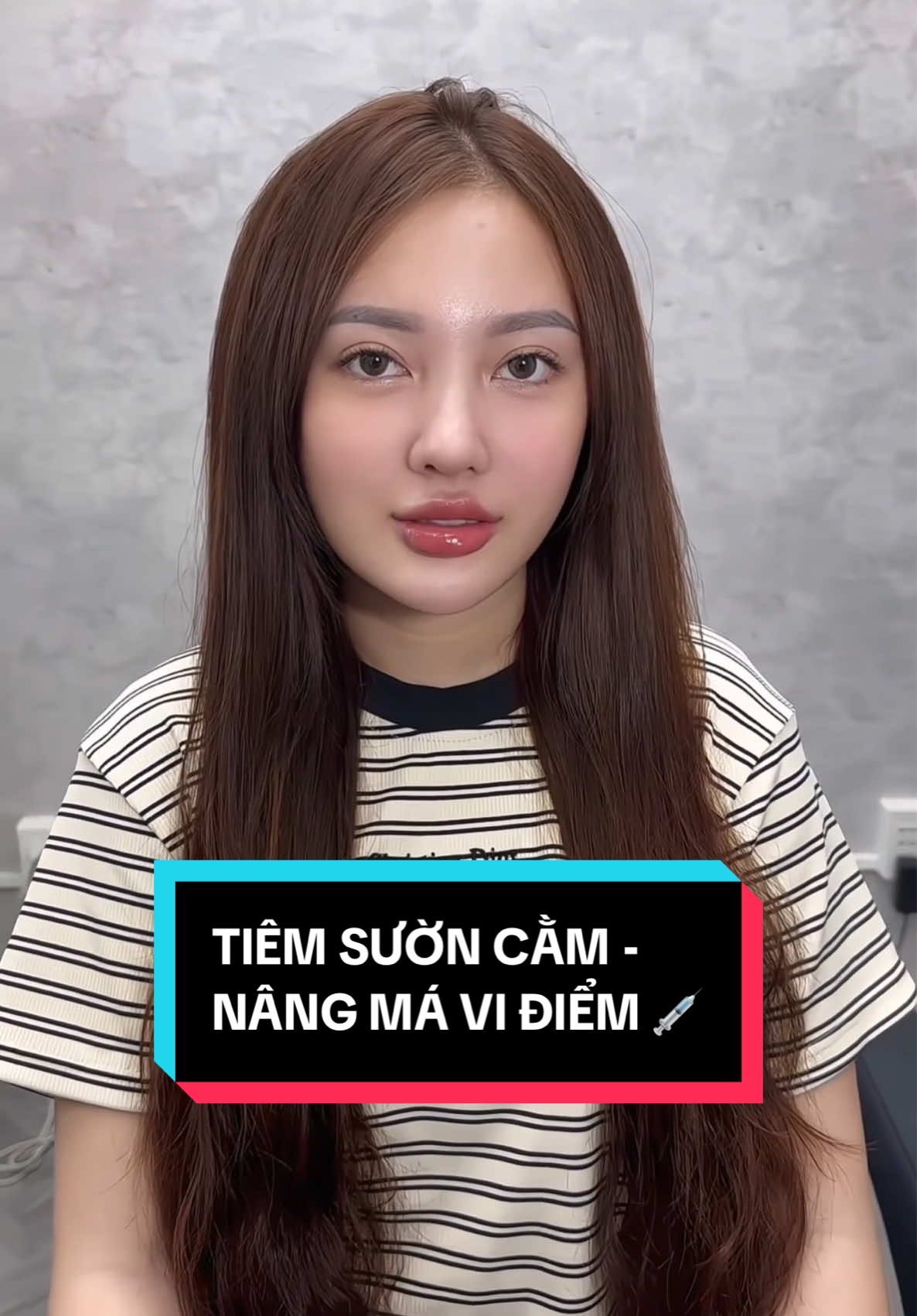 Em bé tiêm combo sườn cằm , nâng má vi điểm và môi căng mọng 💉 #tienleacadamy #filler #botox #TienLeAcademy 