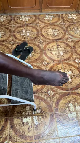 Este paciente terminou 12 doses de PQT, melhorou da queimação nas mãos, mas apresenta perda de força nos pés e dedos , o que dificulta a caminhada. Ele tem levado quedas, por causa dessa instabidade nos pés. Na consulta de hoje, prescrevi mais 12 doses de tratamento. A cura da hanseníase não é automática, só porque o paciente tomou 12 cartelas de remédio. Um paciente “curado” precisa ter melhora evidente ! Este paciente não está curado e por isso vai tomar mais 1 ano de PQT. Espero que ele melhore bastante com esse novo ciclo de tratamento .#hanseniase #queimaçãonospés #neuropatia #dorcronica #fibromialgia 