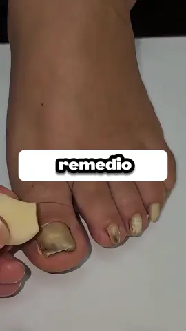 El Secreto Mejor Guardado de la Medicina Natural para los Hongos.  Descubre el potente remedio casero con ajo, alcohol, vinagre y Vicks para los hongos en las uñas. Conoce la ciencia de este 