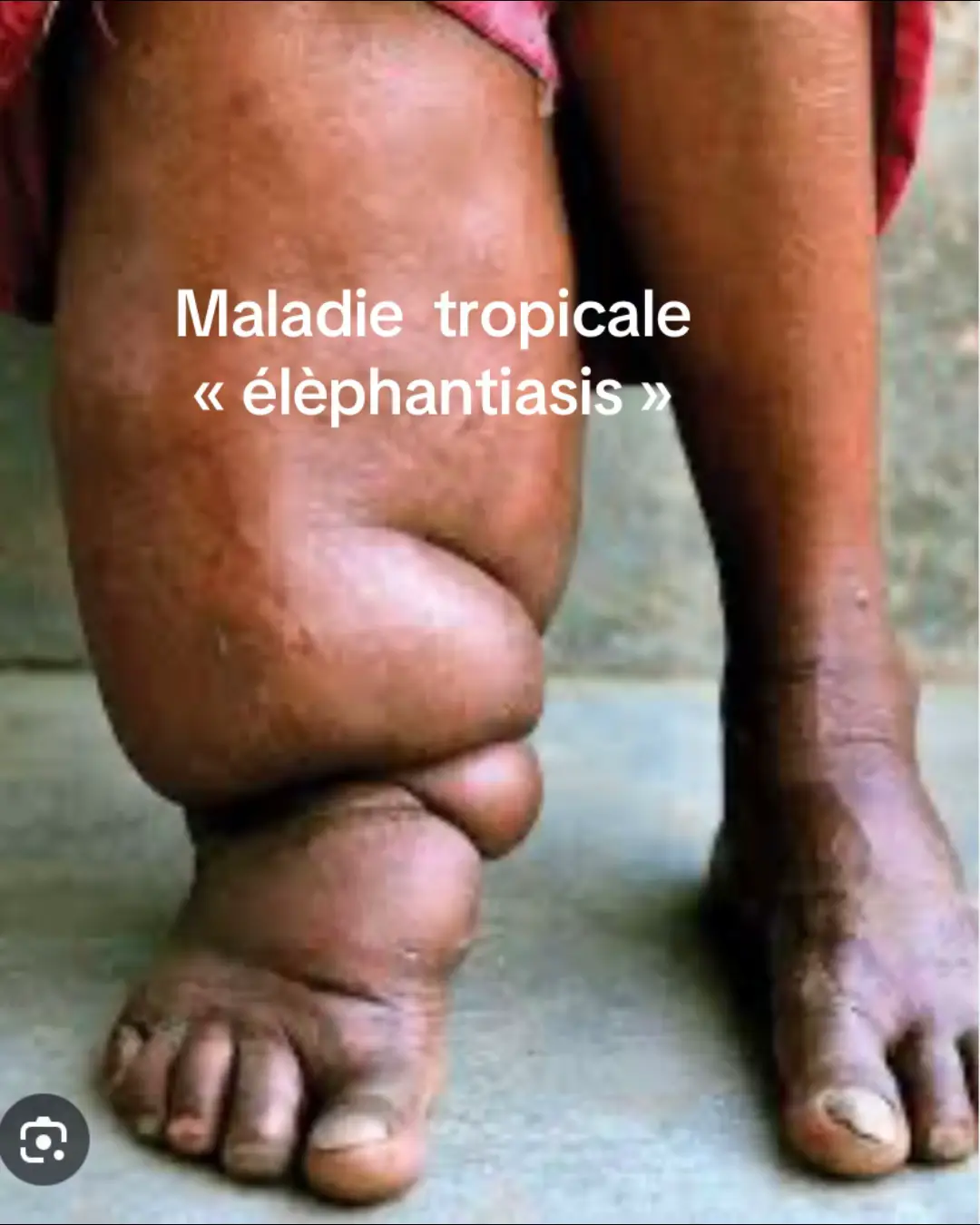 C’est un gonflement d’un membre ou d’une partie du corps. Elle a un aspect semblable à un patte d’élèphant d’où son appellation «ÉLÈPHANTIASIS »Cette symptôme est une maladie tropicale infectieuse  due à des petits parasites provenant d’Afrique et d’Asie qui se loge dans le sang et les tissus humains qui se transmettent par les moustiques, leur vecteur. Les larves sont des microfilaires vivants dans le sang. Ces parasites se trouvent dans le système lymphatique d’où les obstrue et entraînent un gonflement. Symptômes : Fièvre  Difficultés à respirer  Des saignements  Une jaunisse  Une fatigue extrême Des convulsions Des globules rouges infectés obstrue des vaisseaux sanguins qui irriguent le cerveau et peut être mortel Traitement : Plusieurs stratégies comme des massages, bandages, compressions, une bonne hygiène cutanée  #elephantiasis #conseilsanté #prevention #soignants #candlebusiness #lolosecandlemagic #tiktok🇫🇷 