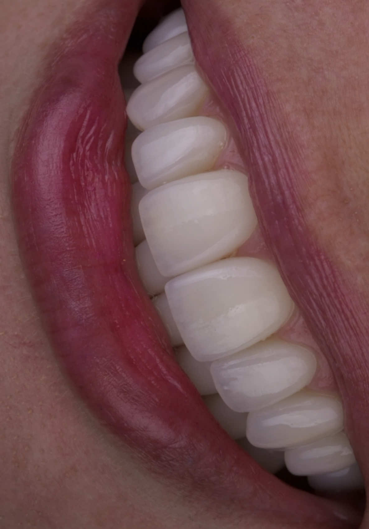 Qué tal este cambio ? Precisión milimétrica y extranaturalidad para un resultado perfecto 🤩 cambio de carillas cerámicas por lentes cerámicos. . #smiledesign #odontologíaestética #naturalsmiledesign 