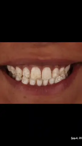 تجميل الاسنان من السعفة بإستخدام القشور الخزفية الاقل بردا للأسنان  #بنغازي_ليبيا✂️🔥🇱🇾🔥🇱🇾🔥🇱🇾 #بنغازي_ليبيا🇱🇾 
