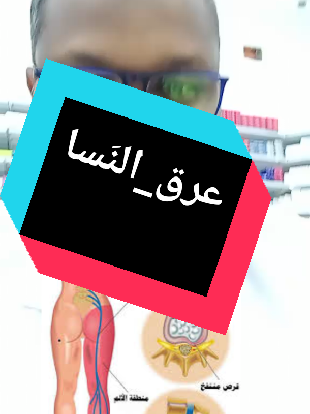 #عرق_النَسا_sciatica #tiktokpromote2023  #صيدلانكو_saydalancoo  # 