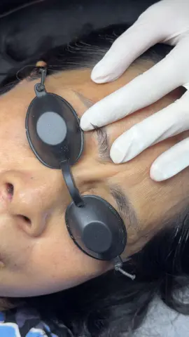 Clip xoá chân mày laser lại lên vairal rồi#phunxambienhoa #xoachanmaylaser #xoachanmay #xoaxamlaser 