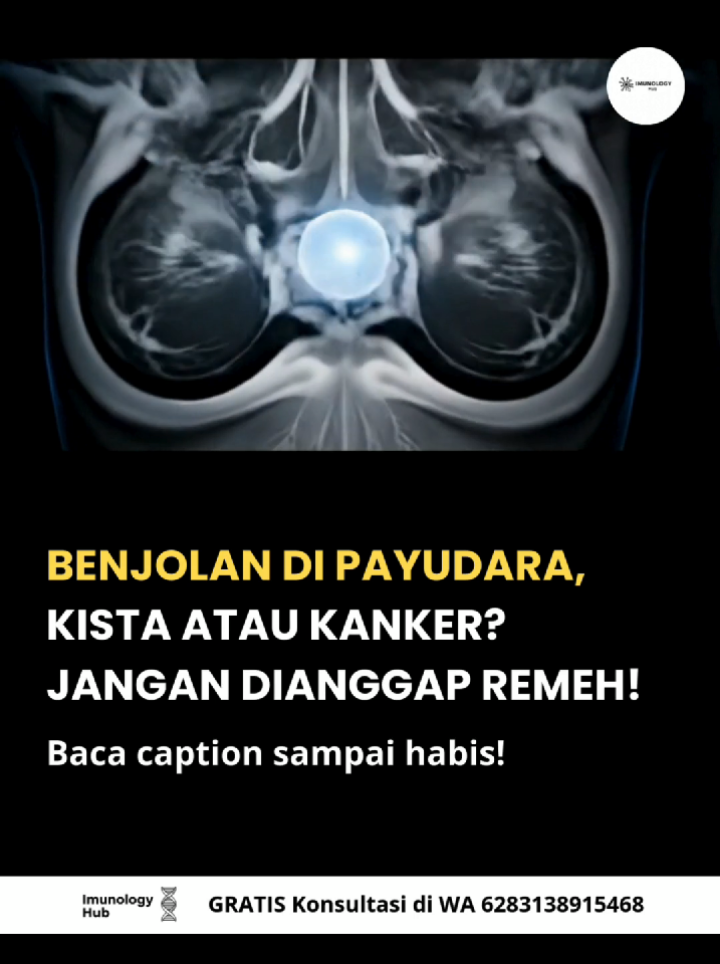 Banyak wanita panik saat menemukan benjolan di payudara. Tapi pertanyaannya: 👉 Apakah ini kista yang jinak, atau justru kanker yang berbahaya? 🩺 Kista payudara adalah kantung berisi cairan yang terbentuk di jaringan payudara. Biasanya terasa lunak atau kenyal saat disentuh, bisa berpindah posisi, dan kadang muncul menjelang menstruasi karena pengaruh hormon. Kista umumnya tidak berbahaya, tapi tetap harus diawasi. ⚠️ Kanker payudara berbeda. Ini terjadi ketika sel-sel abnormal tumbuh tak terkendali dan membentuk benjolan padat. Biasanya terasa keras, menempel di jaringan (tidak bisa digerakkan), bisa disertai perubahan kulit, puting tertarik ke dalam, atau keluar cairan yang tidak normal. Kanker payudara jelas jauh lebih berbahaya dan butuh penanganan medis segera. Masalahnya, dari luar keduanya bisa terlihat mirip. Itulah kenapa tidak boleh menebak-nebak. Hanya pemeriksaan medis yang bisa memastikan apakah benjolan itu kista jinak atau kanker ganas. 🚨 Jangan menunda! Semakin cepat diketahui, semakin besar peluang mencegah kondisi lebih parah. 📲 Kalau kamu atau orang terdekat menemukan benjolan di payudara, segera konsultasikan. Hubungi WA 083138915468 untuk Konsultasi GRATIS. Dan jangan lupa follow akun ini supaya tidak ketinggalan info kesehatan penting lainnya.