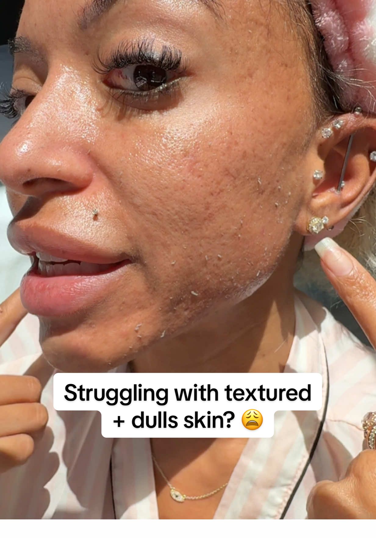 My skin has been looking so much brighter and smoother since I added the Dr. Melanin Peel Shot into my routine 🌸 It’s gentle but really helps with dullness + dark spots. Linked it here so you can try it too ✨ #skincare #darkspots #glowingskin #tiktokshopfinds
