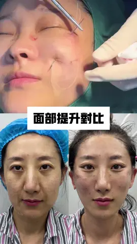 諮詢line：say0099 #法令紋改善 #臉部提升  #幼態臉#輪廓固定#Face lift