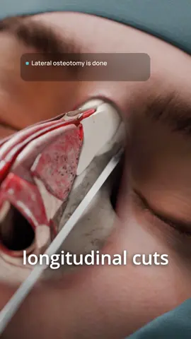 How do Osteotomy and Tip Sculpting create a new profile? Part 3 |3D visualization Following skeletonization, the next critical phase is reshaping the nasal framework itself. This involves precise modification of the bone and cartilage to create a smoother, more balanced dorsum and a defined tip. 🩺 How is it done?  The procedure often begins with addressing a dorsal hump. An osteotome is used to precisely resect the protruding bony and cartilaginous components. This is followed by refinement with a rasp to achieve a perfectly smooth and balanced nasal profile. To narrow the dorsum and close the open roof, a lateral osteotomy mobilizes the nasal bones. The alar cartilages are then reshaped and sutured to create a refined, functional nasal tip. 📌 See these intricate techniques performed on a detailed 3D model on our YouTube channel VOKA 3D Anatomy & Pathology! #rhinoplasty #3danimation #plasticsurgery #humanbody #medicalanimation          