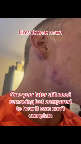 #cystpop #spot #nhs #scar 