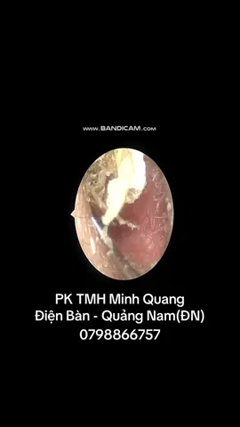 Vệ sinh tai cho bệnh nhân tại PK. #noisoitaimuihong #ráytai 