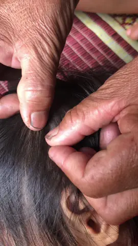 lice remove part 230#Love #vira #for #fyp 